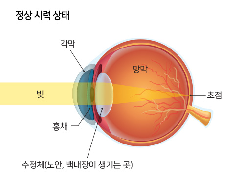 정상 시력 상태