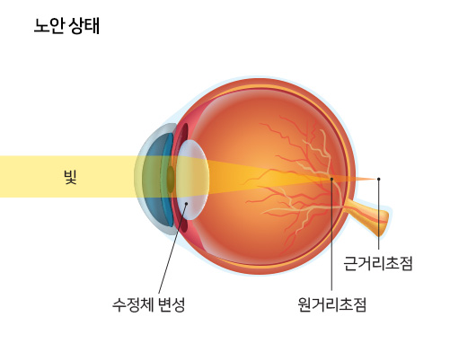 노안 상태