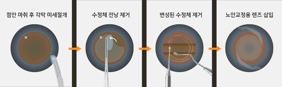 1. 점안 마취 후 각막 미세절개 / 2. 수정체 전낭 제거 / 3. 변성된 수정체 제거 / 4. 노안교정용 렌즈 삽입