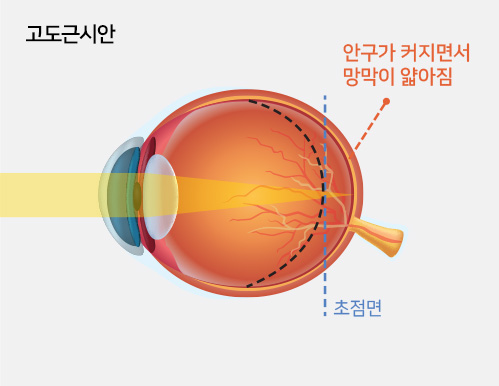 고도근시안 - 안구가 커지면서 망막이 얇아짐