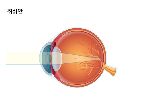정상안