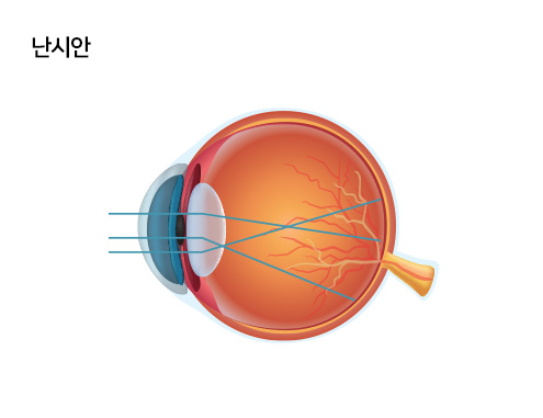 난시안