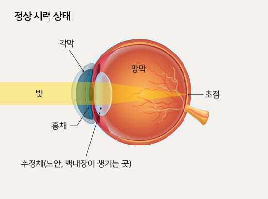정상 시력 상태
