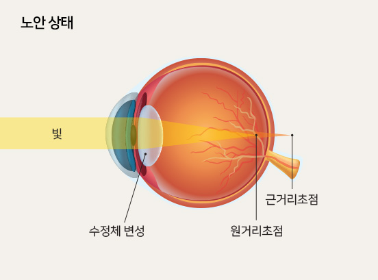 노안 상태