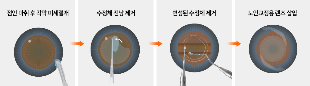 1. 점안 마취 후 각막 미세절개 / 2. 수정체 전낭 제거 / 3. 변셩된 수정체 제거  / 4. 노안교정용 렌즈 삽입