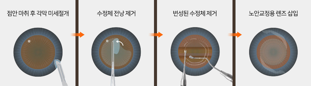 1. 점안 마취 후 각막 미세절개 / 2. 수정체 전낭 제거 / 3. 변성된 수정체 제거 / 4. 노안교정용 렌즈 삽입