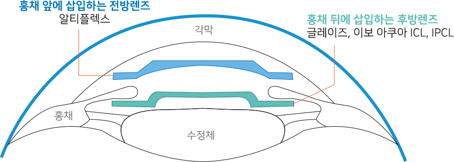 홍채 앞에 삽입하는 전방렌즈 - 알티플렉스, 홍채 뒤에 삽입하는 후방 렌즈 - 글레이즈, 이보 아쿠아 ICL, IPCL