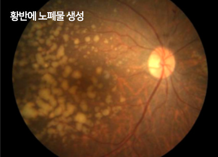 황반에 노폐물 생성