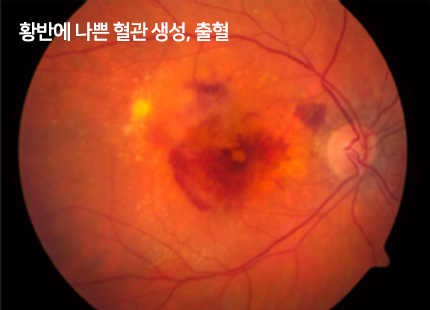 황반에 나쁜 혈관 생성, 출혈