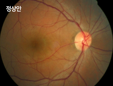 정상안