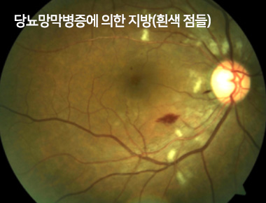 당뇨망막병증에 의한 지방(흰색 점들)