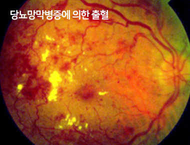 당뇨망막병증에 의한 출혈