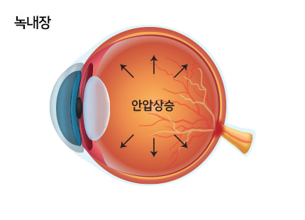 녹내장
