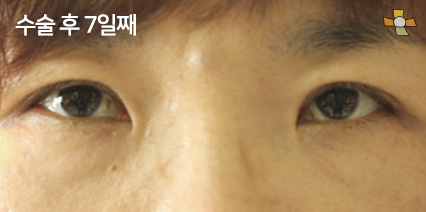 수술 후 7일째