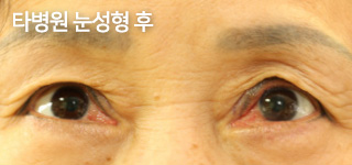 타병원 눈성형 후