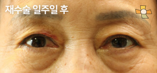 재수술 일주일 후