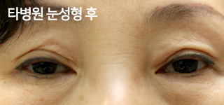 타병원 눈성형 후