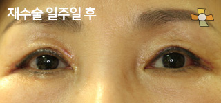 재수술 일주일 후