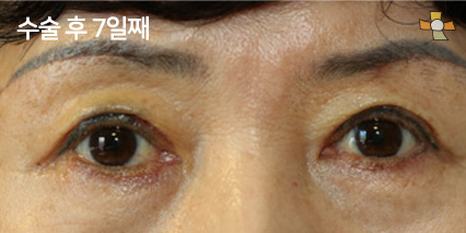 수술 후 7일째