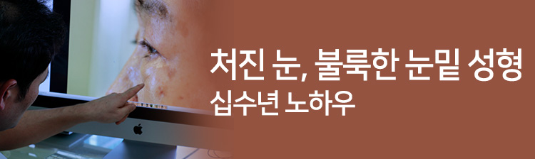 처진 눈, 불룩한 눈밑 성형 십수년 노하우