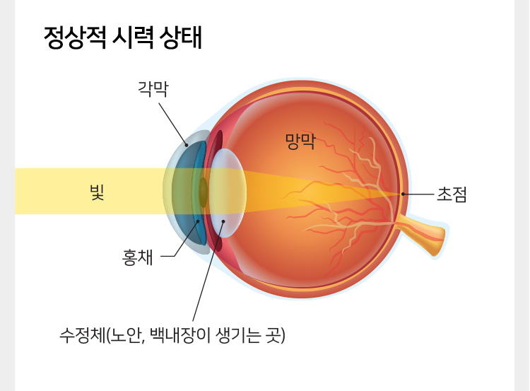 정상 시력 상태