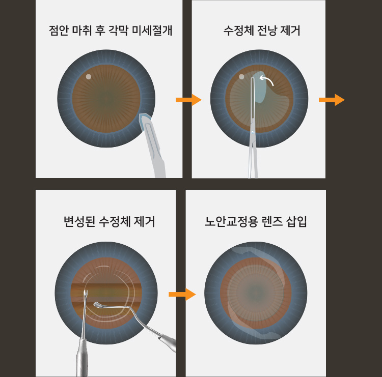 1. 점안 마취 후 각막 미세절개 / 2. 수정체 전낭 제거 / 3. 변성된 수정체 제거 / 4. 노안교정용 렌즈 삽입