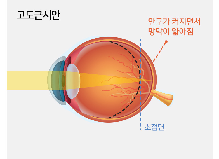 고도근시안 - 안구가 커지면서 망막이 얇아짐