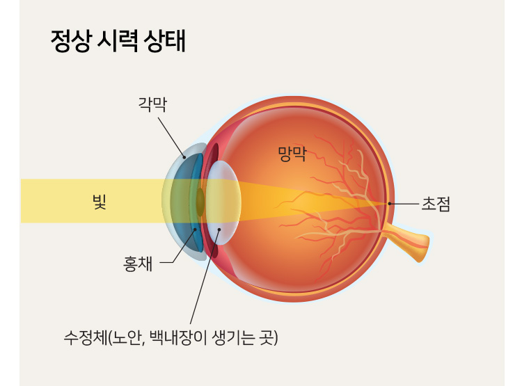 정상 시력 상태