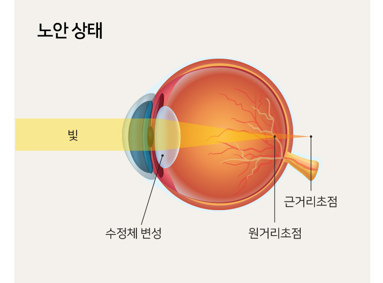 노안 상태