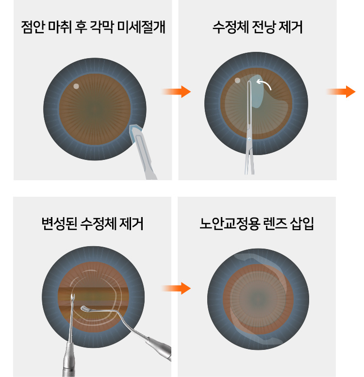 1. 점안 마취 후 각막 미세절개 / 2. 수정체 전낭 제거 / 3. 변셩된 수정체 제거  / 4. 노안교정용 렌즈 삽입