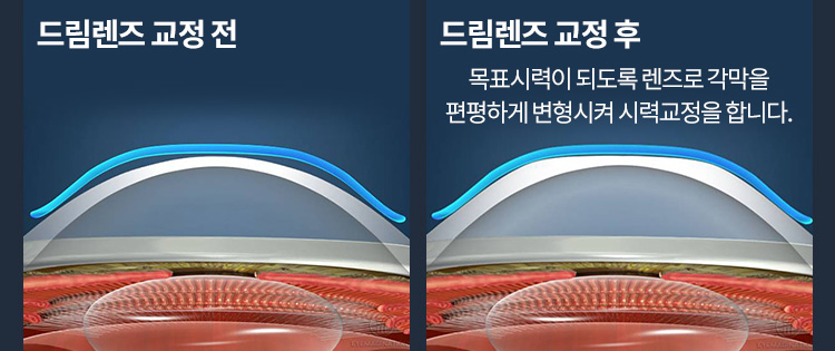 드림렌즈 교정 전 / 드림렌즈 교정 후(목표시력이 되도록 렌즈로 각막을 편평하게 변형시켜 시력교정을 합니다.)
