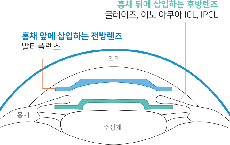 홍채 앞에 삽입하는 전방렌즈 - 알티플렉스, 홍채 뒤에 삽입하는 후방 렌즈 - 글레이즈, 이보 아쿠아 ICL, IPCL
