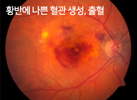 황반에 나쁜 혈관 생성, 출혈