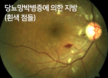 당뇨망막병증에 의한 지방(흰색 점들)
