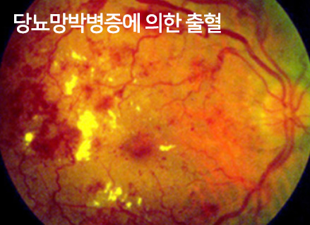 당뇨망막병증에 의한 출혈