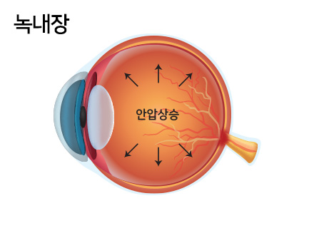 녹내장