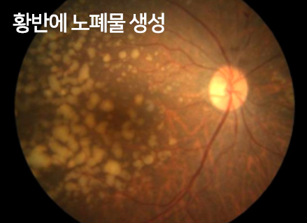 황반에 노폐물 생성