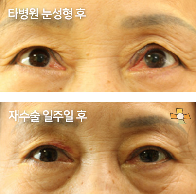 타병원 눈성형 후 > 재수술 일주일 후