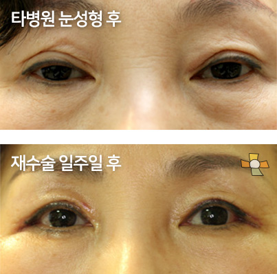 타병원 눈성형 후 > 재수술 일주일 후
