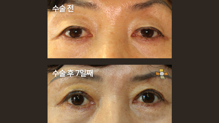 수술 전 > 수술 후 7일째