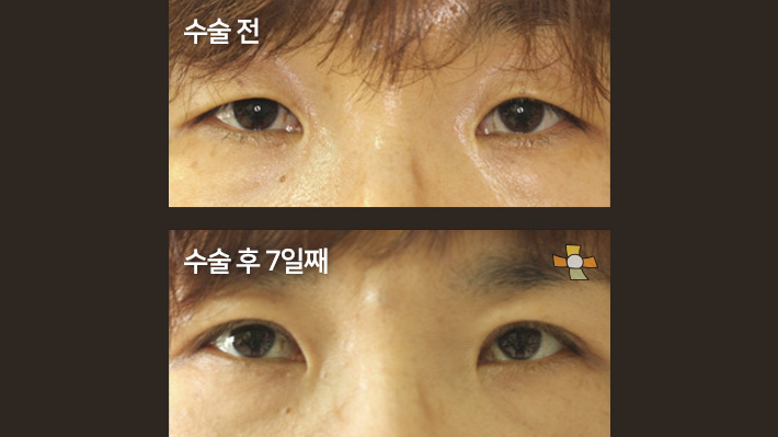 수술 전 > 수술 후 7일째