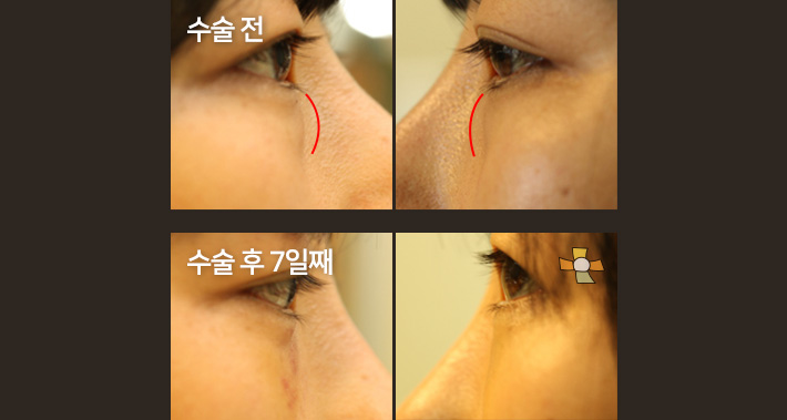 수술 전 > 수술 후 7일째